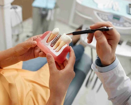 Implantes dentales