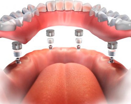 Rehabilitación oral